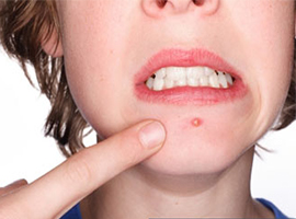 脸上长痘痘了怎么办？ 给你最靠谱的祛痘方法！