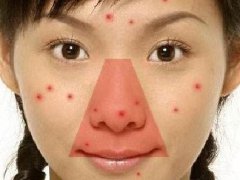 大油皮怎么祛痘?除油消痘秘诀看这里