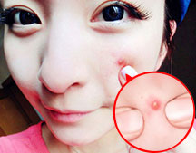 别以为只是痘痘爆发!其实满脸的＂虫＂在爬!