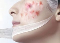 吃辣会长痘？其实甜食更加让你痘痘长不停