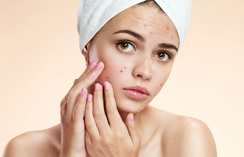 痘痘导致烂脸怎么办?没关系，你有玛尚呀!